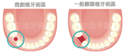 台中微創植牙